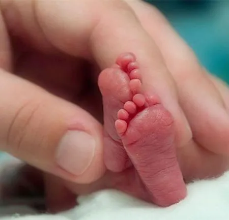 8 ข้อดีของการผ่าตัดคลอด