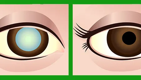 ต้อกระจก โรคตาต้อกระจก เลนส์ตาเทียม