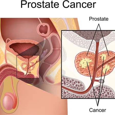 อาหารป้องกัน โรคมะเร็งต่อมลูกหมาก