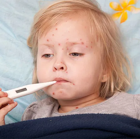 ไข่ ของแสลงอีสุกอีใส จริงหรือไม่