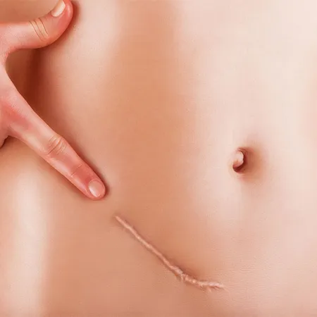 วิธีการรักษาแผลเป็นให้หาย