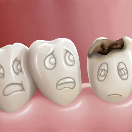 ฟันตกกระ เพราะฟลูออไรด์ในเด็กเล็ก