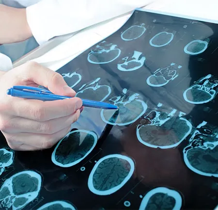 โรคหลอดเลือดสมอง ภัยเงียบที่ไม่อาจมองข้าม