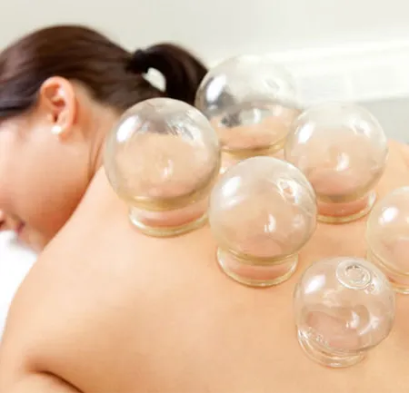 บำบัดโรคด้วยการครอบแก้ว ตามวิถีแพทย์แผนจีน