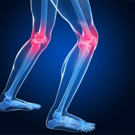 ปัญหาข้อเข่าเสื่อม