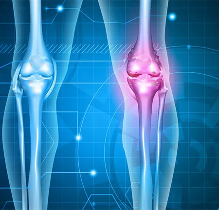 ป้องกันโรคข้อเข่าเสื่อม