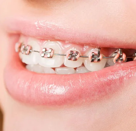 จัดฟันช่วยแก้ปัญหาอะไรบ้าง