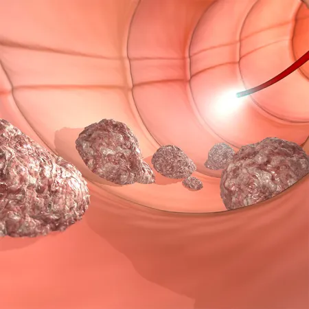 ภัยเงียบมะเร็งลำไส้ใหญ่