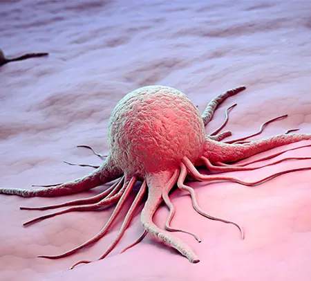 5 อันดับโรคมะเร็งพบมากในเพศชายและเพศหญิง