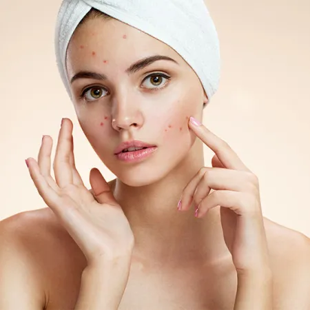 ปัญหาเรื่องสิว