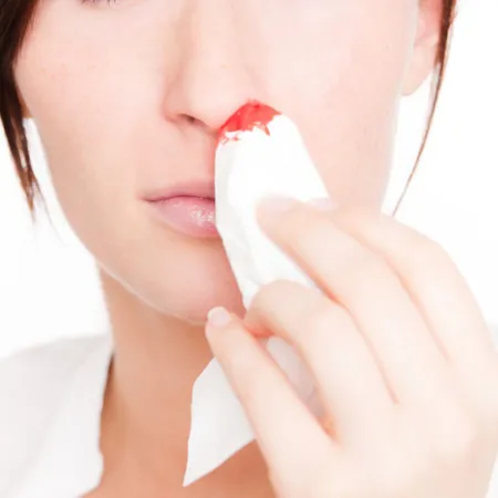 มีเลือดกำเดาไหลออกจากช่องจมูก