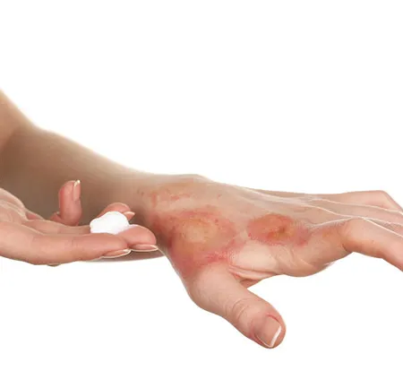 ดูแลเบื้องต้นแผลไฟไหม้น้ำร้อนลวกและแผลจากสารเคมี