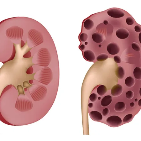 โรคไตเรื้อรัง ภัยเงียบที่ควรระวัง