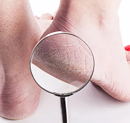 ส้นเท้าแห้งแตกดูแลอย่างไร